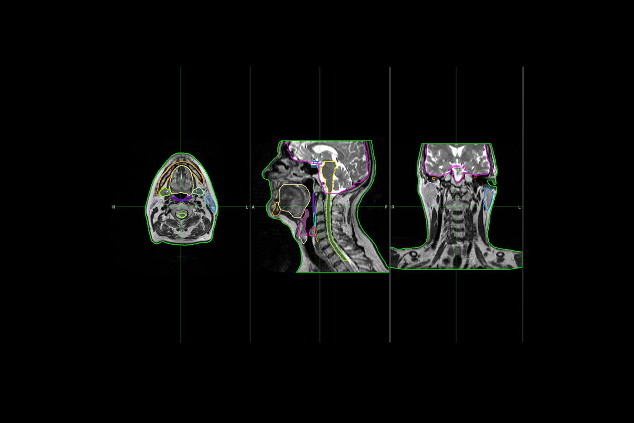 FeatureHero3-MRIforradiationtherapy-MRContourDL