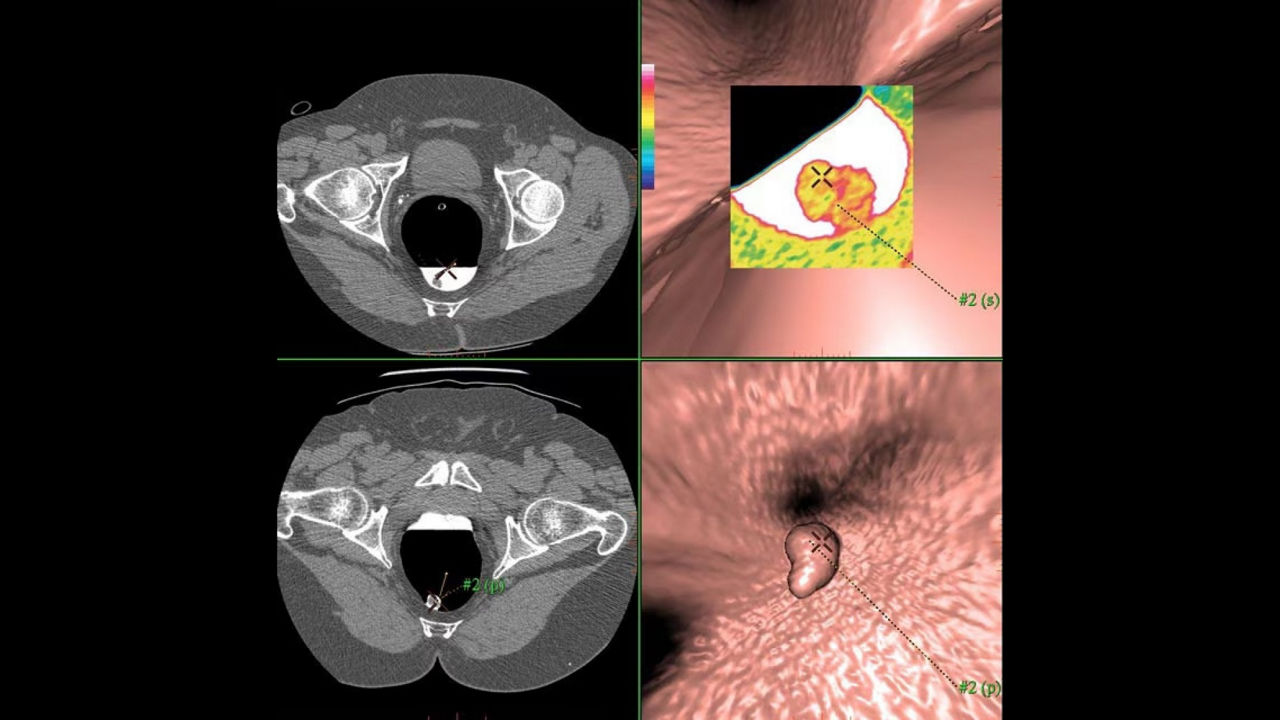 features-efficient-reading-coloniclesion-detection-desktop