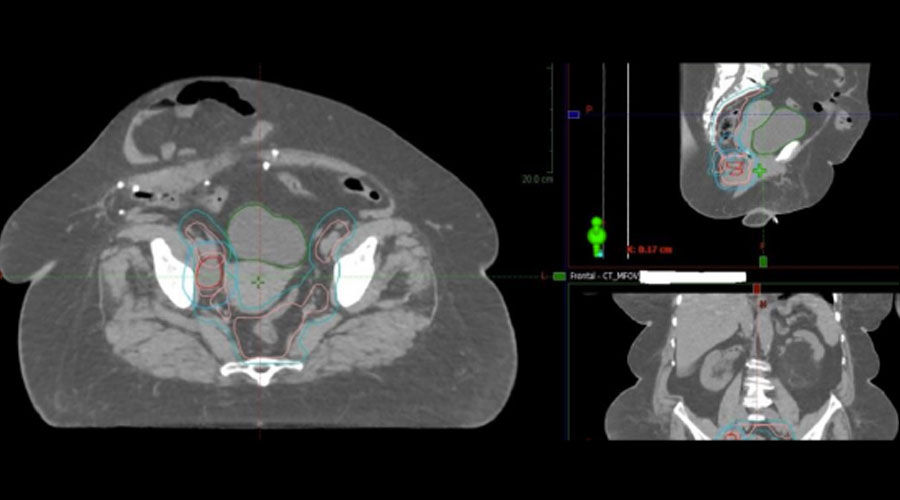 Female-patients-with-cancer-in-anal-canal-Full-Size