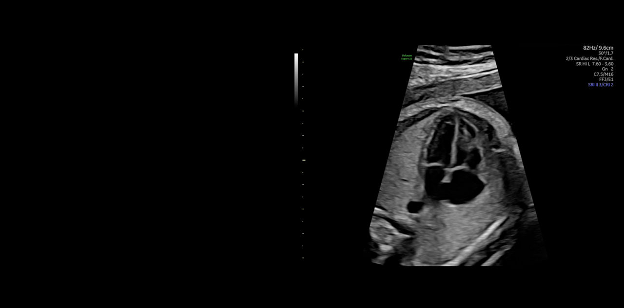 Fetal Heart Detection