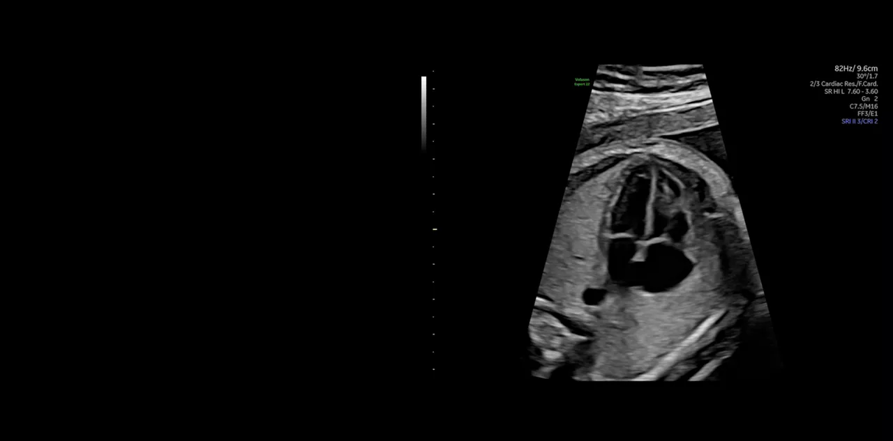 Fetal Heart Detection