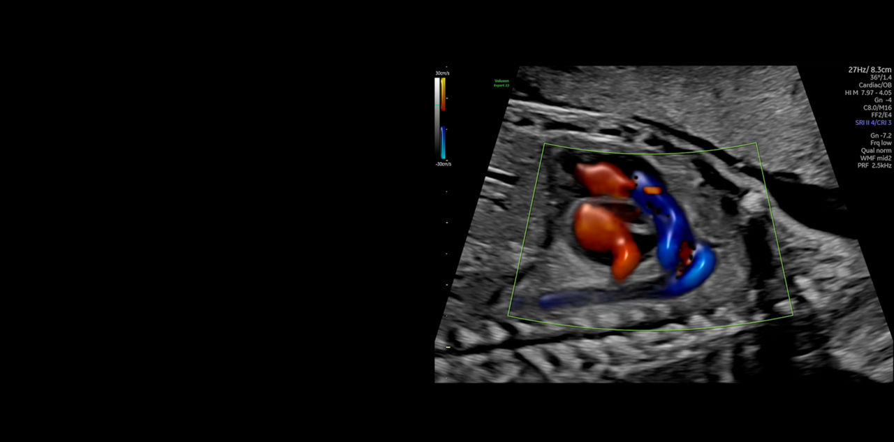 Fetal Heart Diagnosis