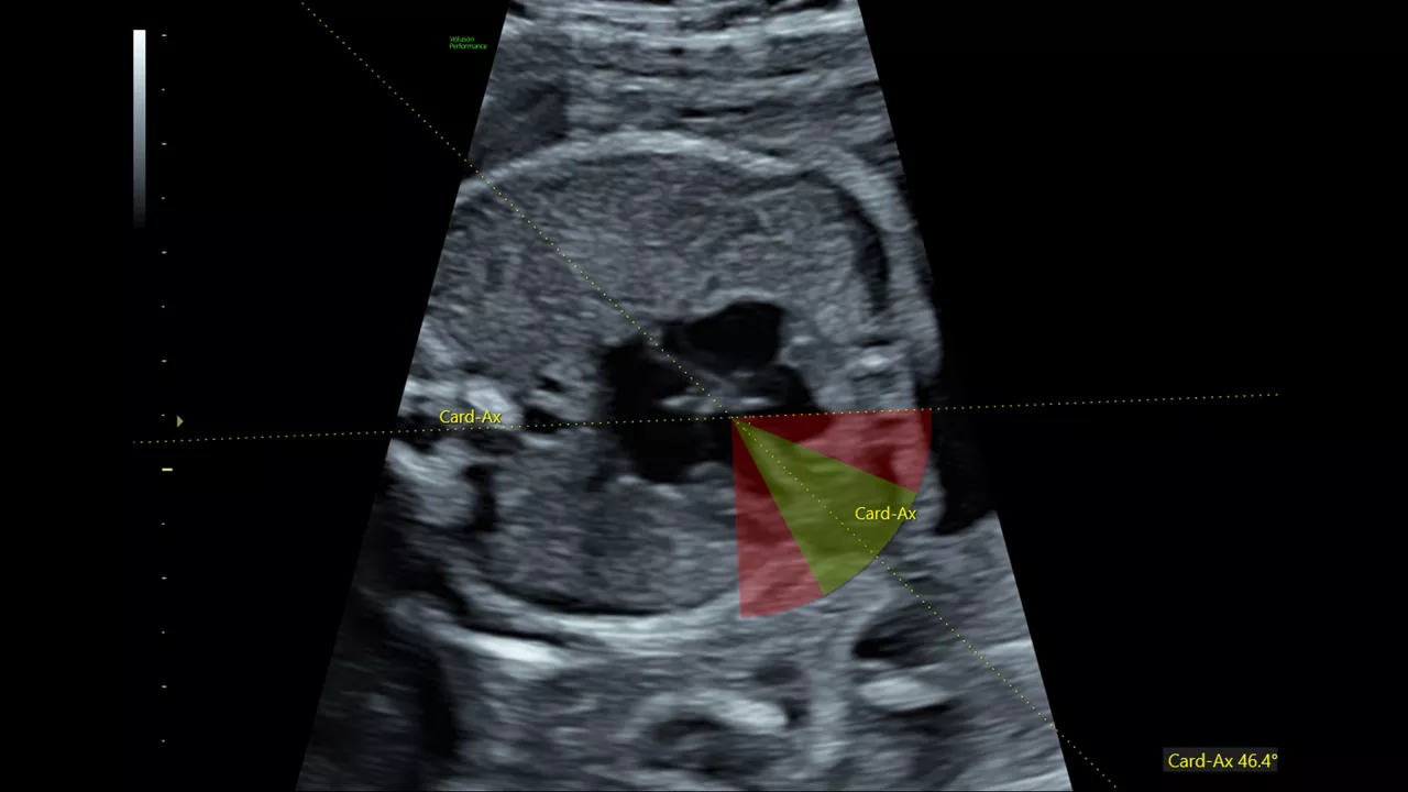 fetal-hs