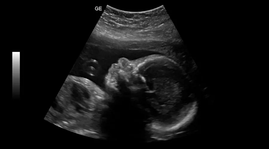 fetal-profile