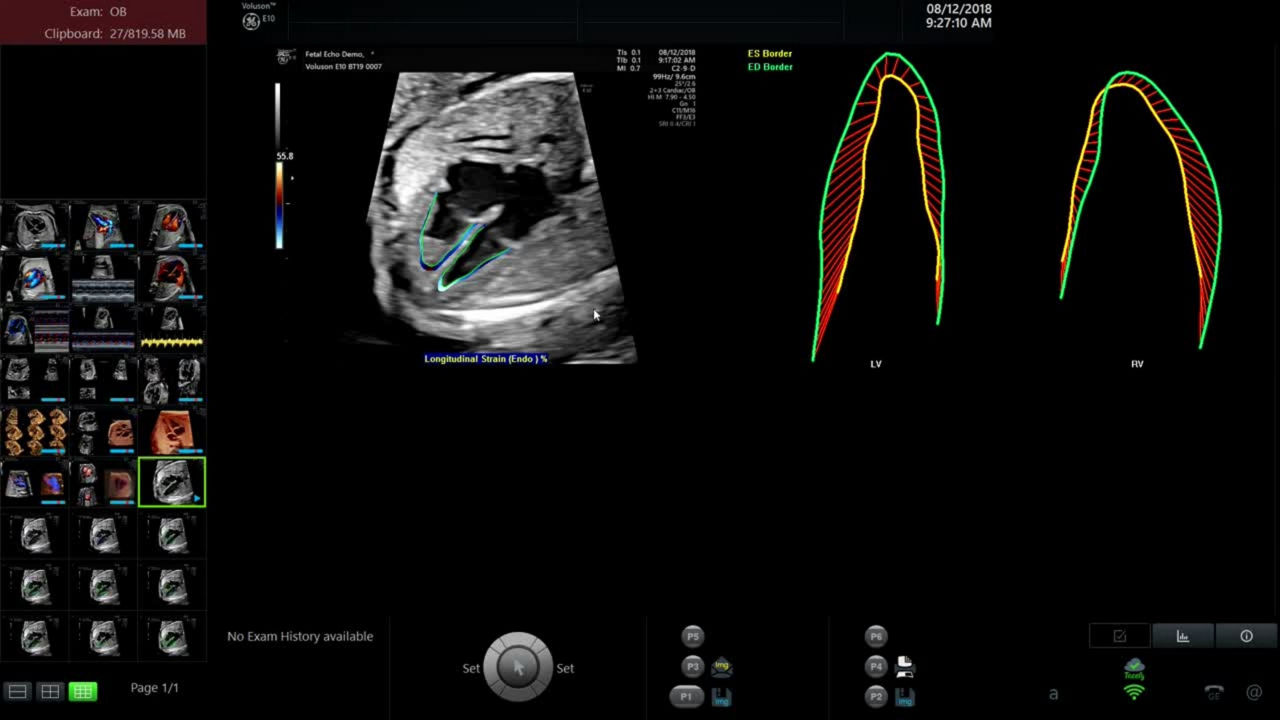 fetalhq-video1-thumbnail-ci-en