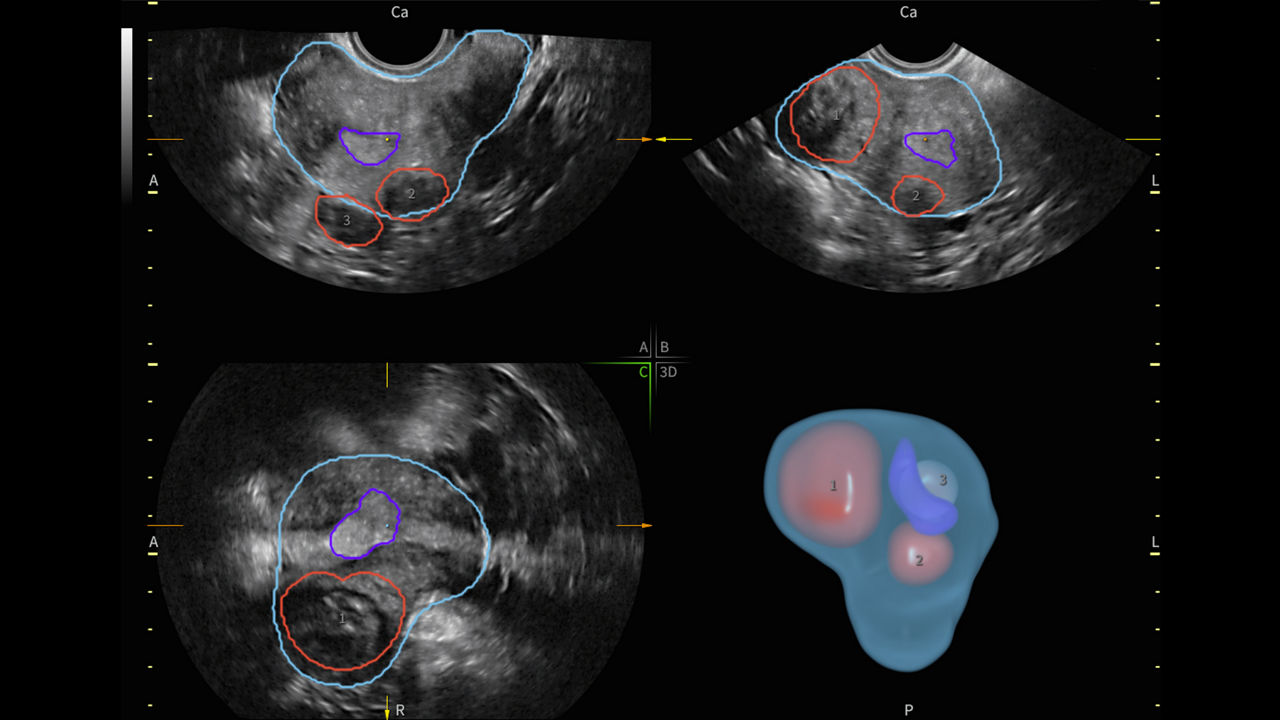 fibroid-mapping