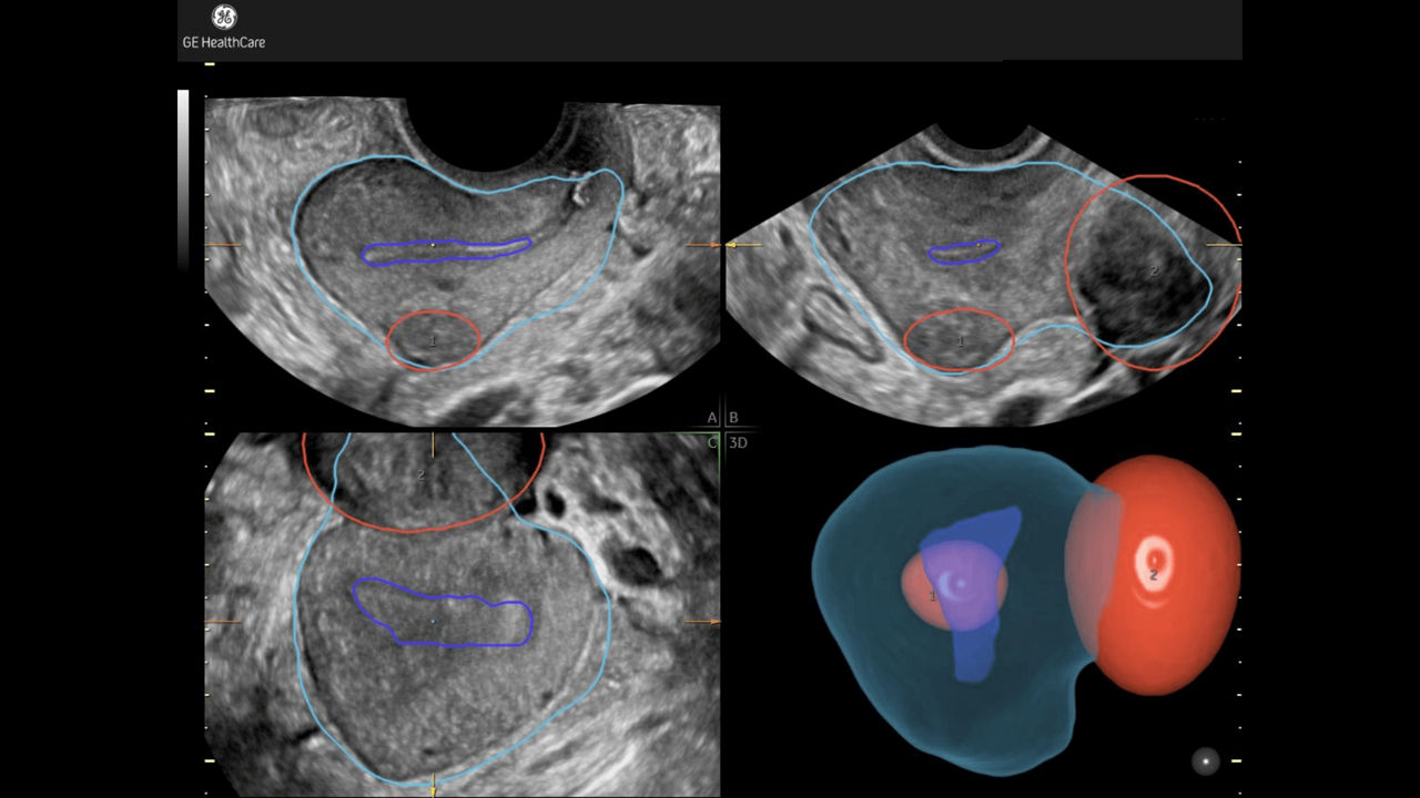 Fibroid-Mapping-Feature card Desktop