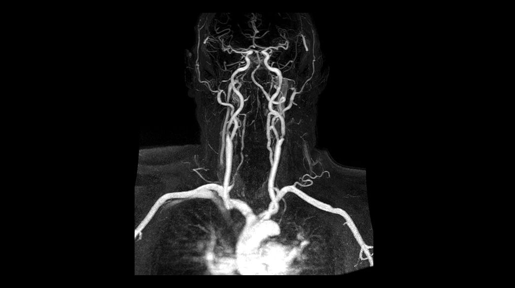 Fluoro-Trigger-MRA1040-x-585