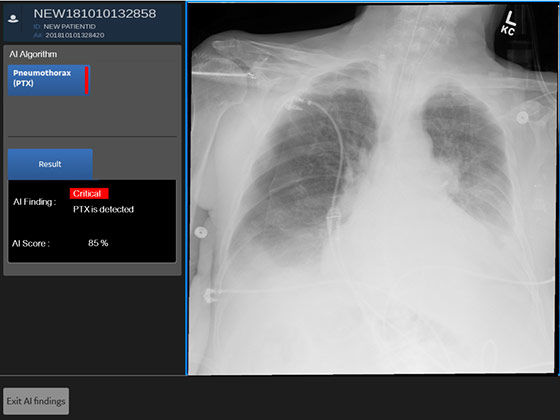 frontal-chest-x-ray-image