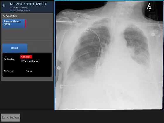 frontal-chest-x-ray-image