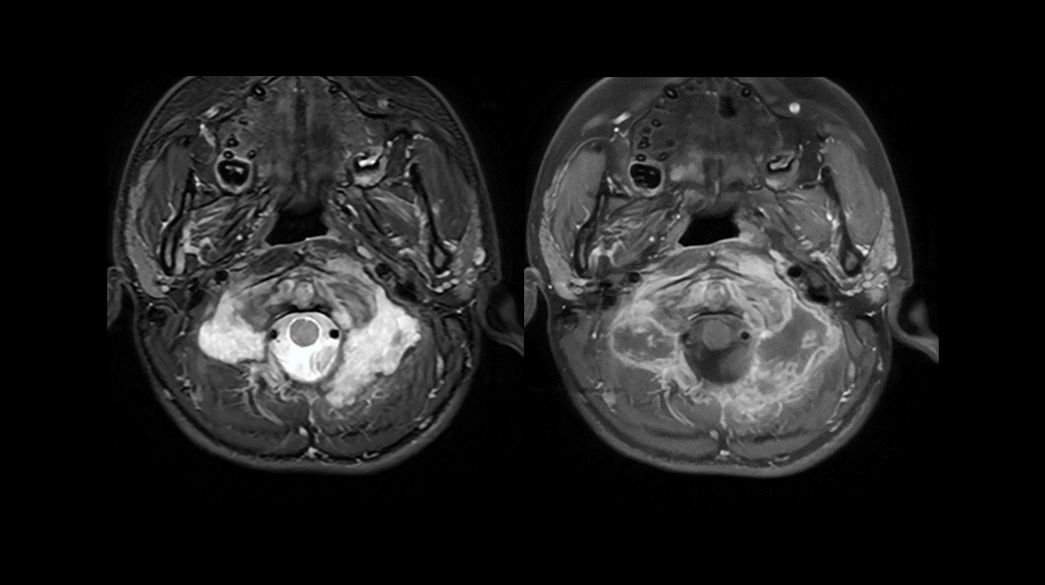 FSE-Flex-Compatible-with-AIRRecon-DL1040-x-585