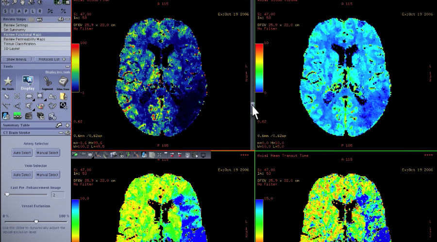 GE-AW-CT-Perfusion-4D-Radiology-Imaging-Software-Video