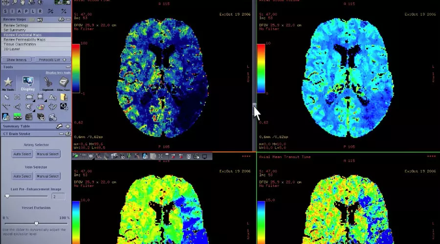 GE-AW-CT-Perfusion-4D-Radiology-Imaging-Software-Video