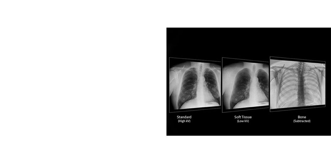 Dual Energy Subtraction