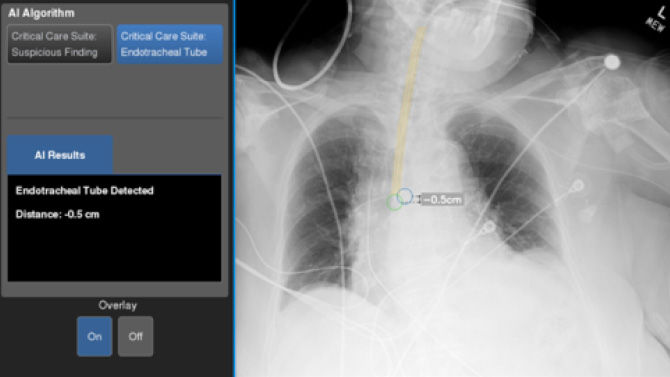 Artificial Intelligence and X-Ray - Impacting Patient Care and Improving Efficiency