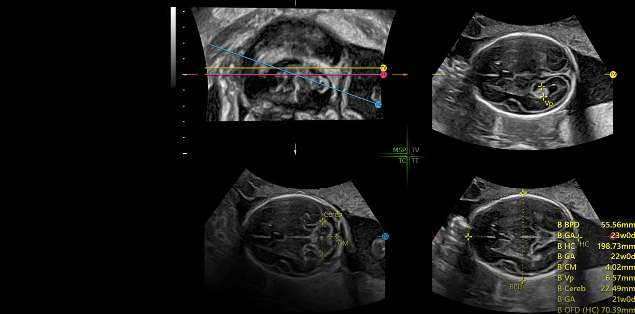 GE_Voluson_E20_Workflow_SonoCNS