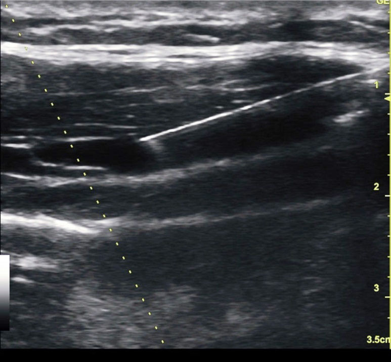 TAP block demonstrating needle  and tip using the 12L-SC