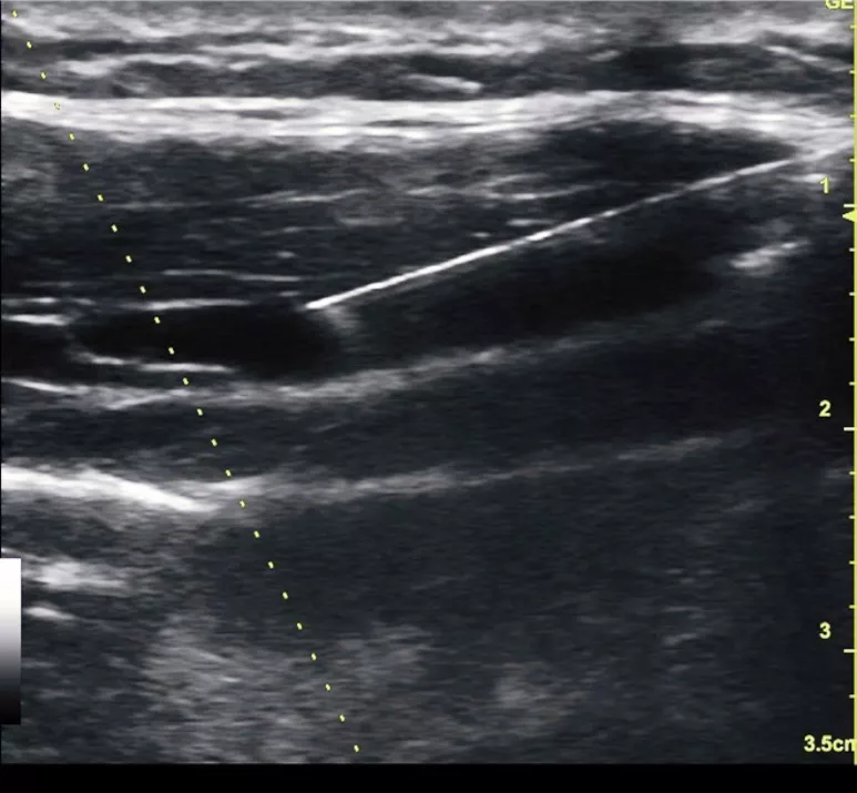 TAP block demonstrating needle  and tip using the 12L-SC