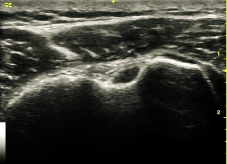 Biceps tendon with 12L-SC transducer