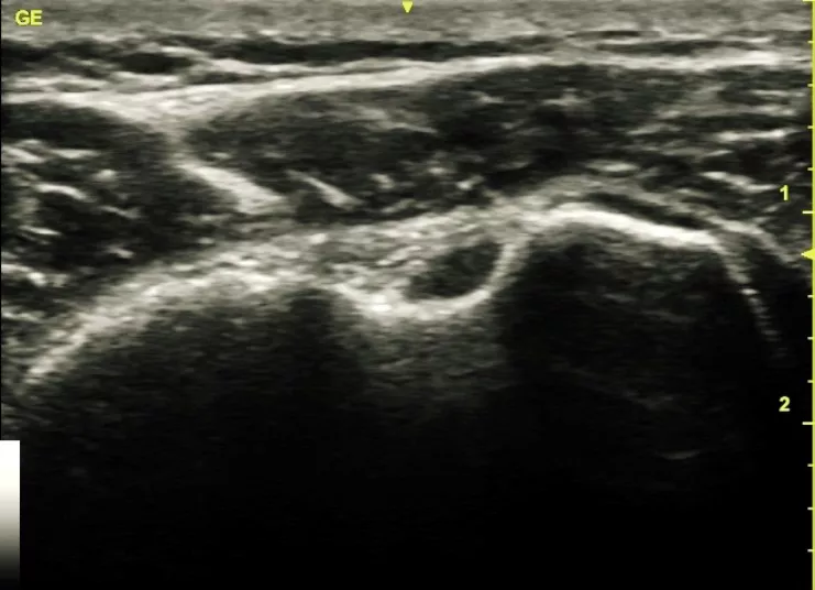 Biceps tendon with 12L-SC transducer