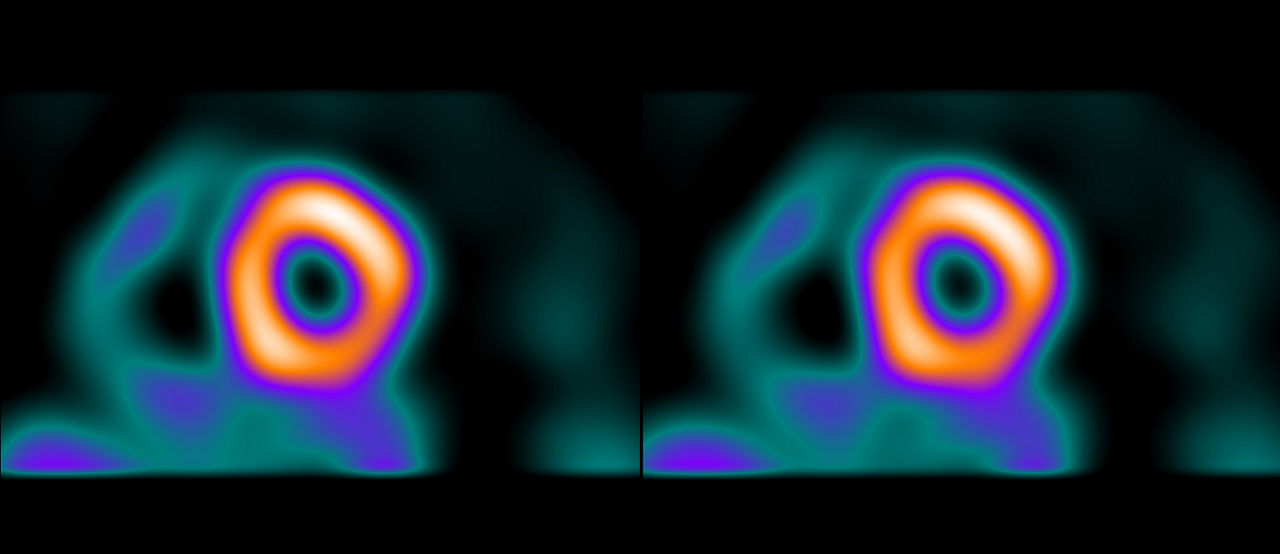 GEHCMyoSPECTPWPMyocardialBloodFlowImage1