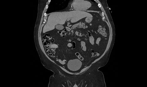GEHCRevolutionAscendClinicalPerformanceImage4