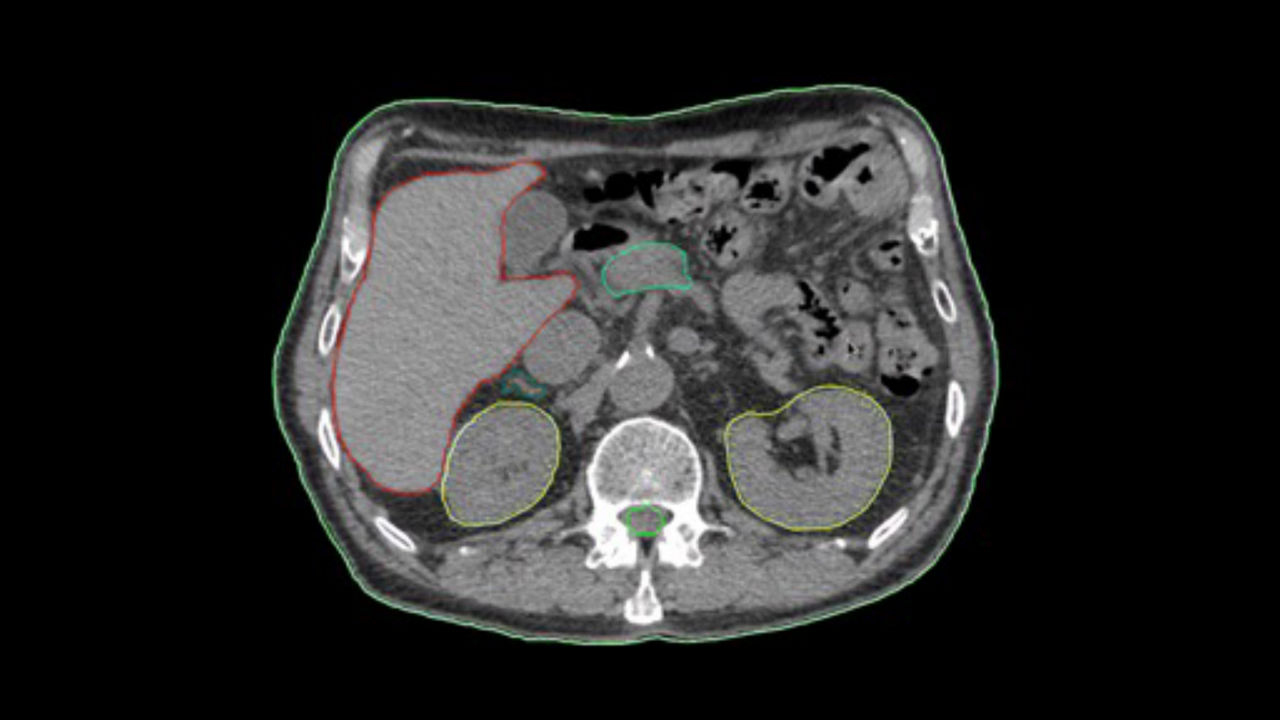 GEHEALTHCARE_CT_SmartSubscription_AutoSegmentation_1920x1080