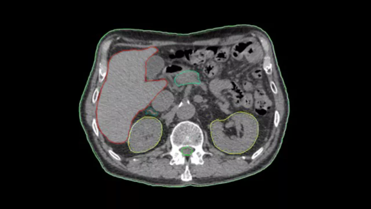 GEHEALTHCARE_CT_SmartSubscription_AutoSegmentation_1920x1080