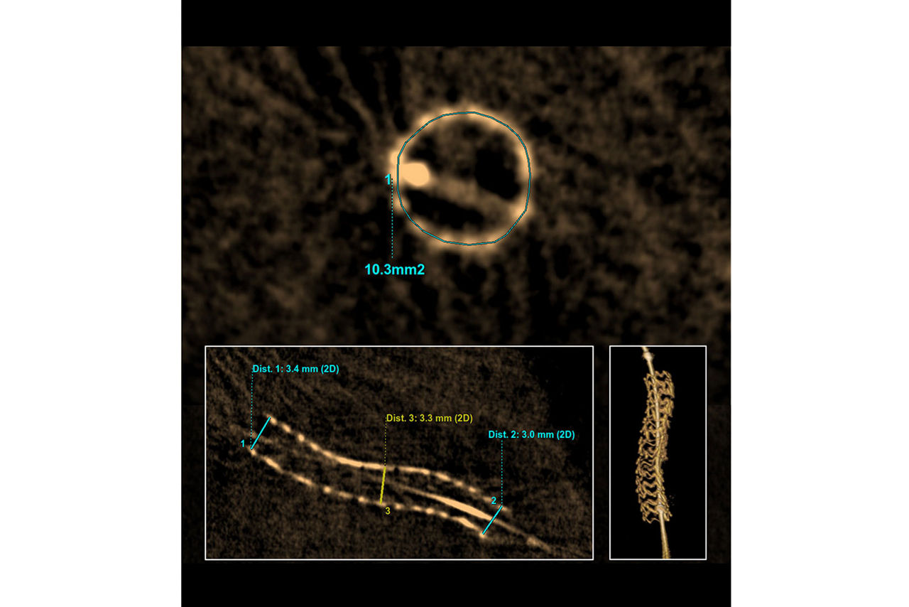 GEHeathCare-3DStent-Measure-MSA-coronary