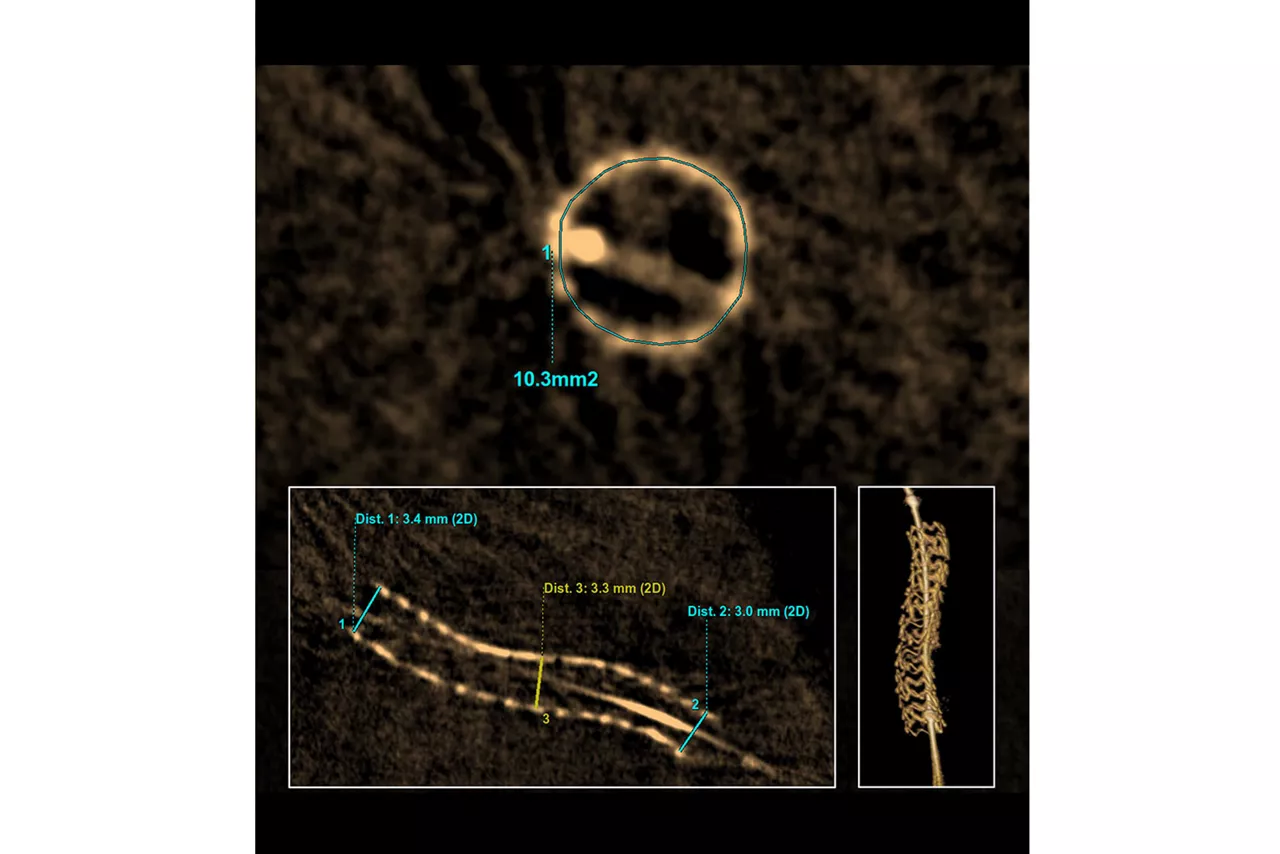 GEHeathCare-3DStent-Measure-MSA-coronary
