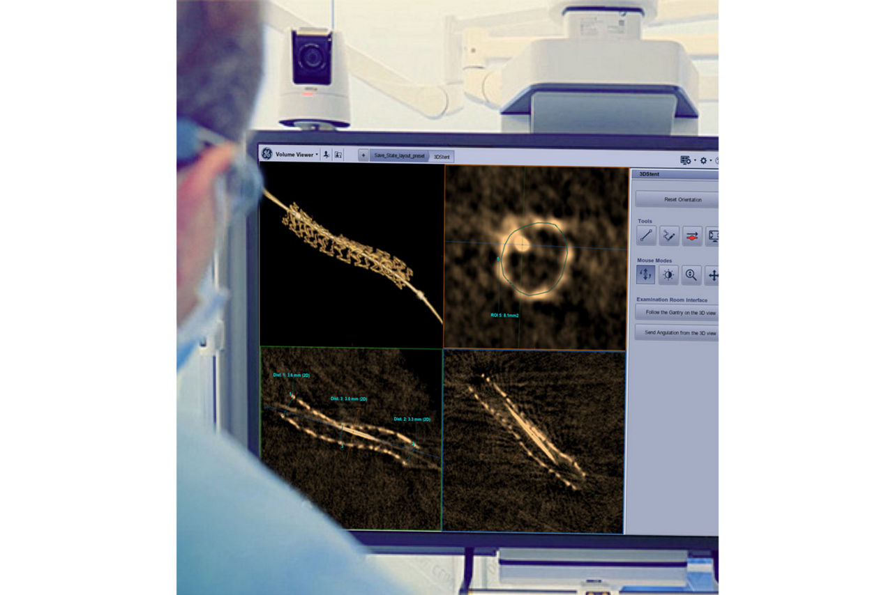 GEHeathCare_3DStent_Live_cathlab_pci