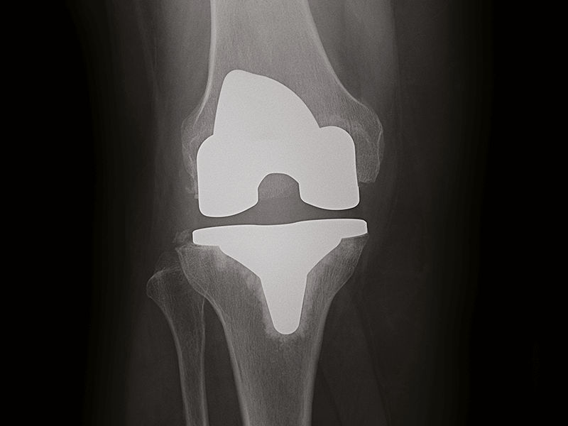 helix-excellent-handling-of-metal-implants-2columns