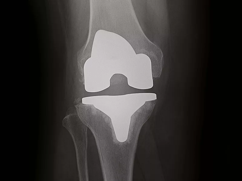 helix-excellent-handling-of-metal-implants-2columns