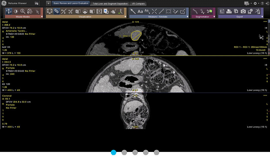 hepatic-vcar-scurve-animated-graphics-advanced-visualization-