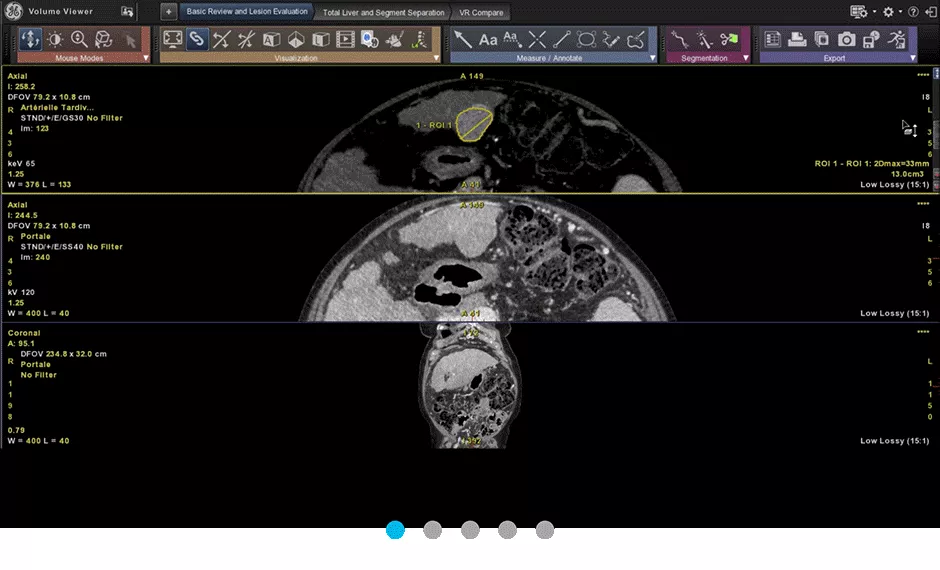 hepatic-vcar-scurve-animated-graphics-advanced-visualization-