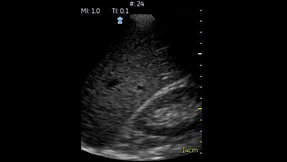 Espacio hepatorenal