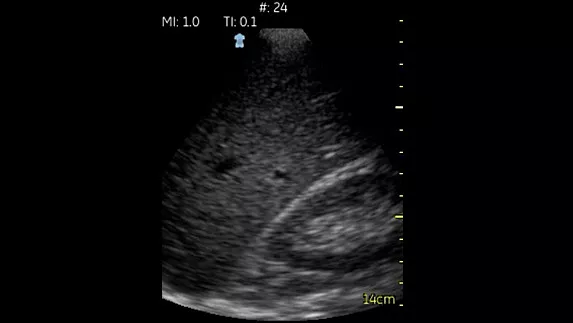 hotspot tours-vscan-hepatorenal-space_jpg