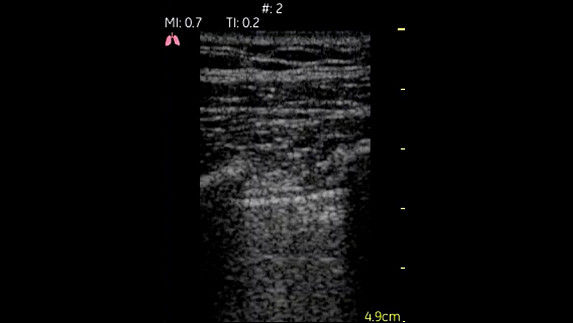 Pulmones