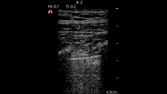 hotspot tours-vscan-lung_pleural-space_1_jpg