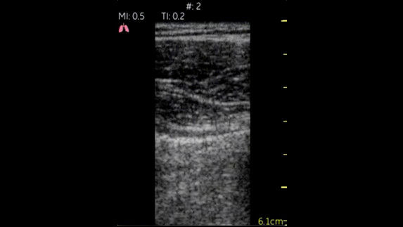 Pulmones