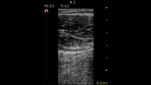 hotspot tours-vscan-lung_pleural-space_2_jpg