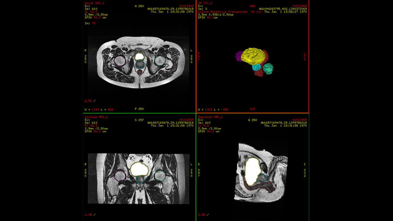 ications-advantagesim-md-gehc-advantagesim-md-ct-atlas-segmentation-organ-segmentation