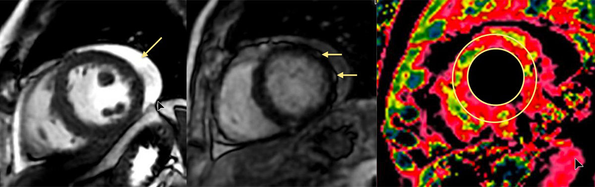 Identifying-acute-cardiovascular-injury-in-COVID-19-patients-with-MR
