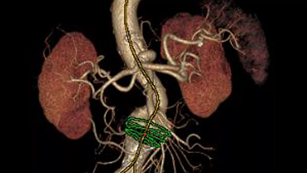 (T)EVAR Assist de GE Healthcare