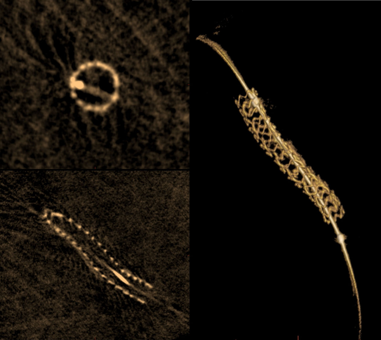 IGSmainpage3DStentTileImage