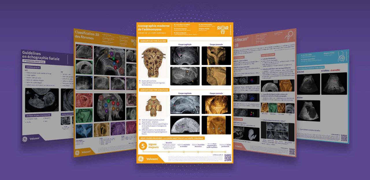 image-full-adenomyose