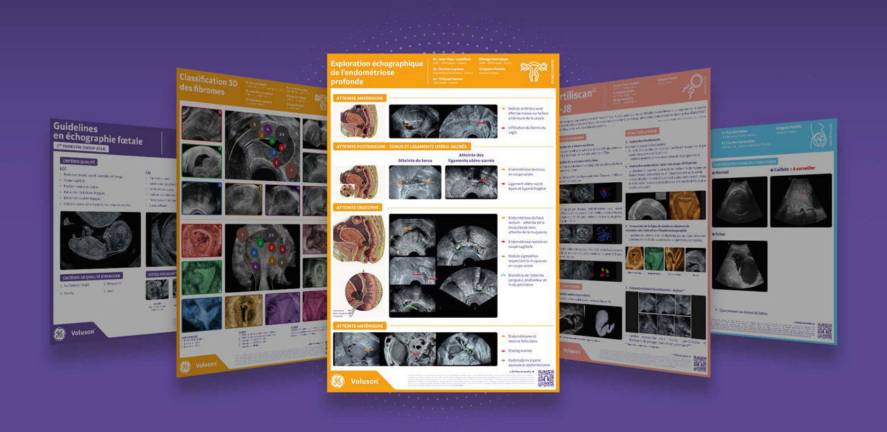 image-full-endometriose