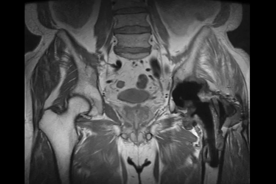 Imaging-around-MR-Conditional-implants
