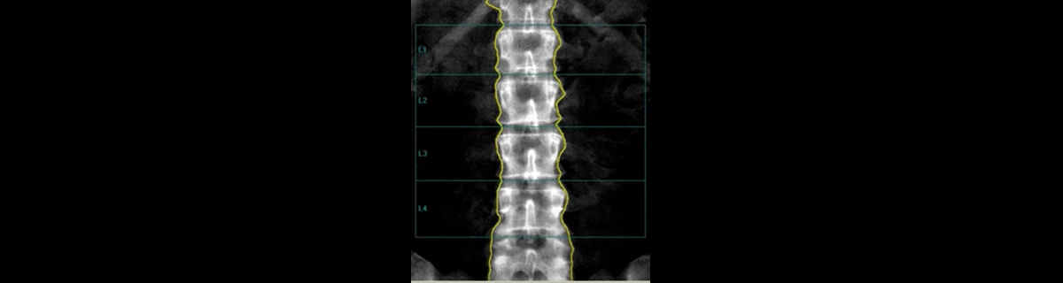 integrating-trabecular-bone-scoring-into-your-clinical-dxa-practice-banner-image-ba-en