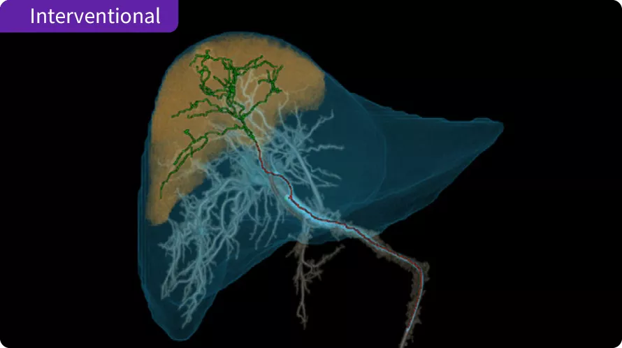Interventional - Liver ASSIST Virtual Parenchyma